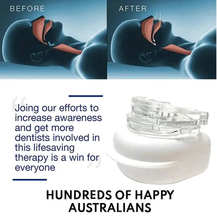 Anti-Snoring Mouthpiece Rieworkes